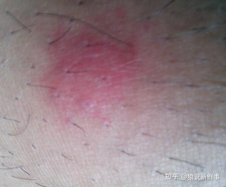 灭蚊子的药对人有害吗_灭蚊子最怕的三种药_什么草药蚊子怕