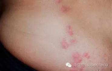 臭虫床虱图片_臭虫图片图库_床板臭虫图片